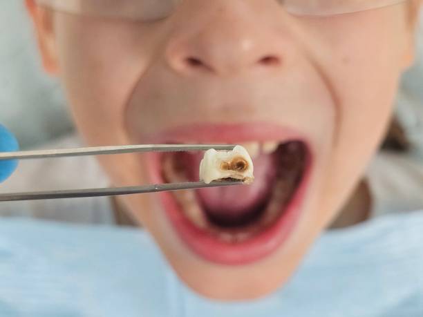 Best Emergency Wisdom Teeth Removal in Tenaha, TX